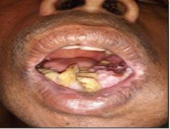 Md. Abdus Salam, Oral cavity cancer