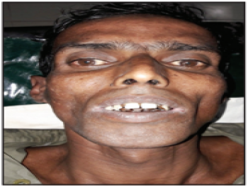 Md. Idris Ali, 53 years, Cancer of Larynx (Voice box)