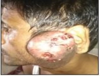Mr. Abdur Razzak, Rickshaw pullar, Parotid Salivary Gland Cancer