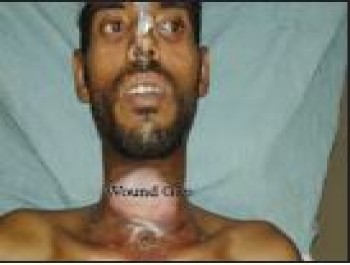 Mr. Saydur , Day laborer , Cancer Larynx (Voice box)