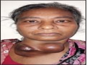 Mrs. Lutfun Nessa , 46 years, Thyroid Cancer