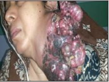 Mrs. Runu, Parotid Salivary gland cancer